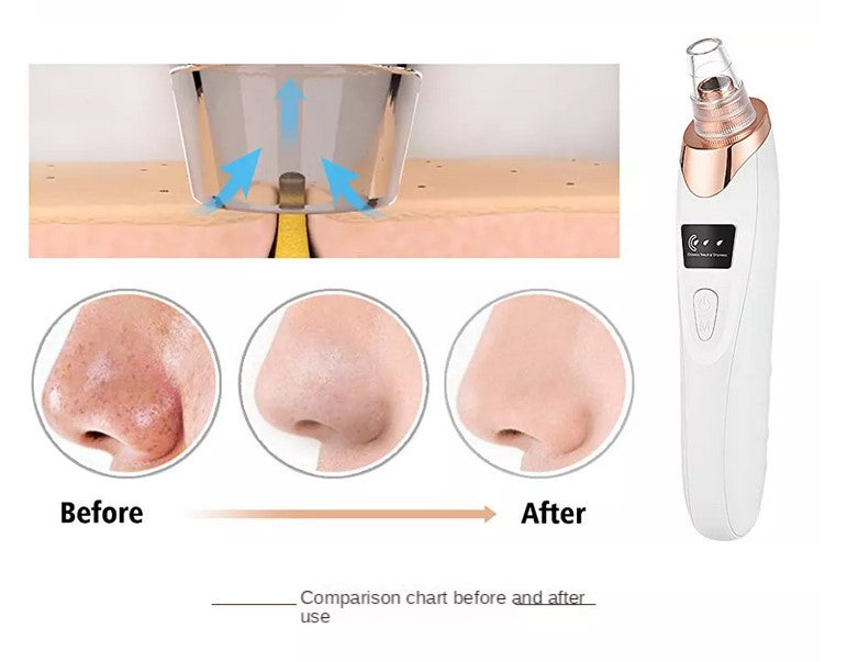 Electric Blackhead Remover